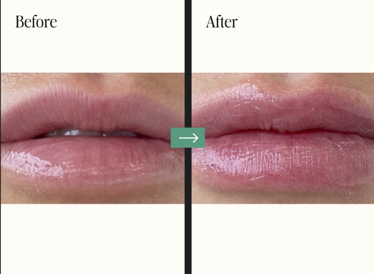 Dermal Fillers Before and After Pictures Charleston, SC